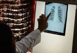 Tuberculosis deaths rise for the first time in more than a decade due to the COVID-19 pandemic