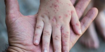 Monkeypox: The disease is incurable and it’s already been found in at least 10 countries