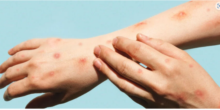 DRC: Government steps up efforts to combat mpox with international support