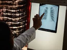 Tuberculosis deaths rise for the first time in more than a decade due to the COVID-19 pandemic